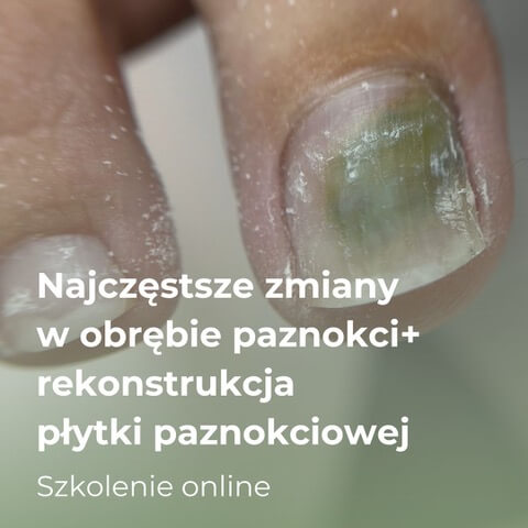 Najczęstsze zmiany w obrębie paznokci